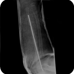 Radius & Ulna Shaft Fractures in 4 year old treated with Flexible IM Nailing