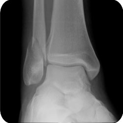 weber a lateral malleolus fracture