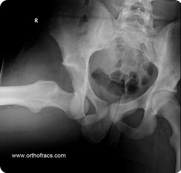 Dislocated Hip