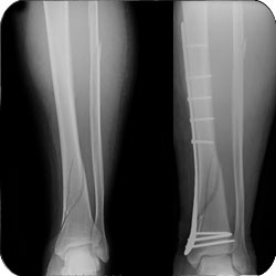 does distal fibula fracture need surgery
