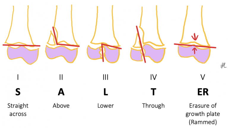 Salter Harris Classification Of Physeal Fractures