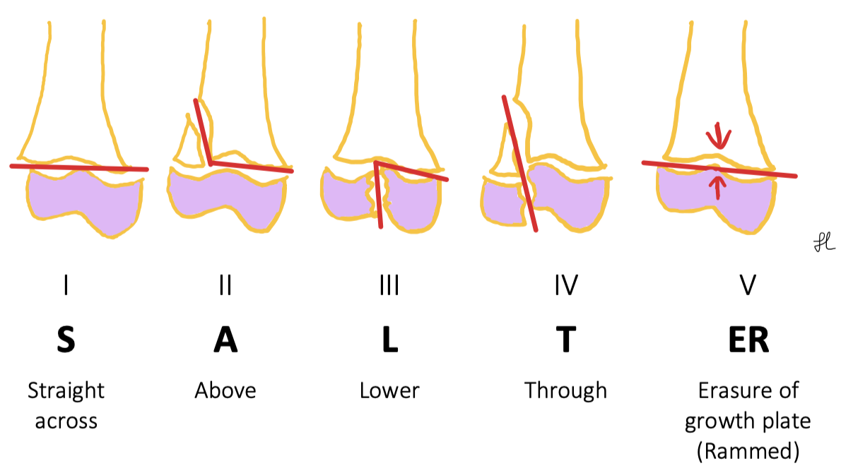 Salter Harris Classification Of Physeal Fractures 0241